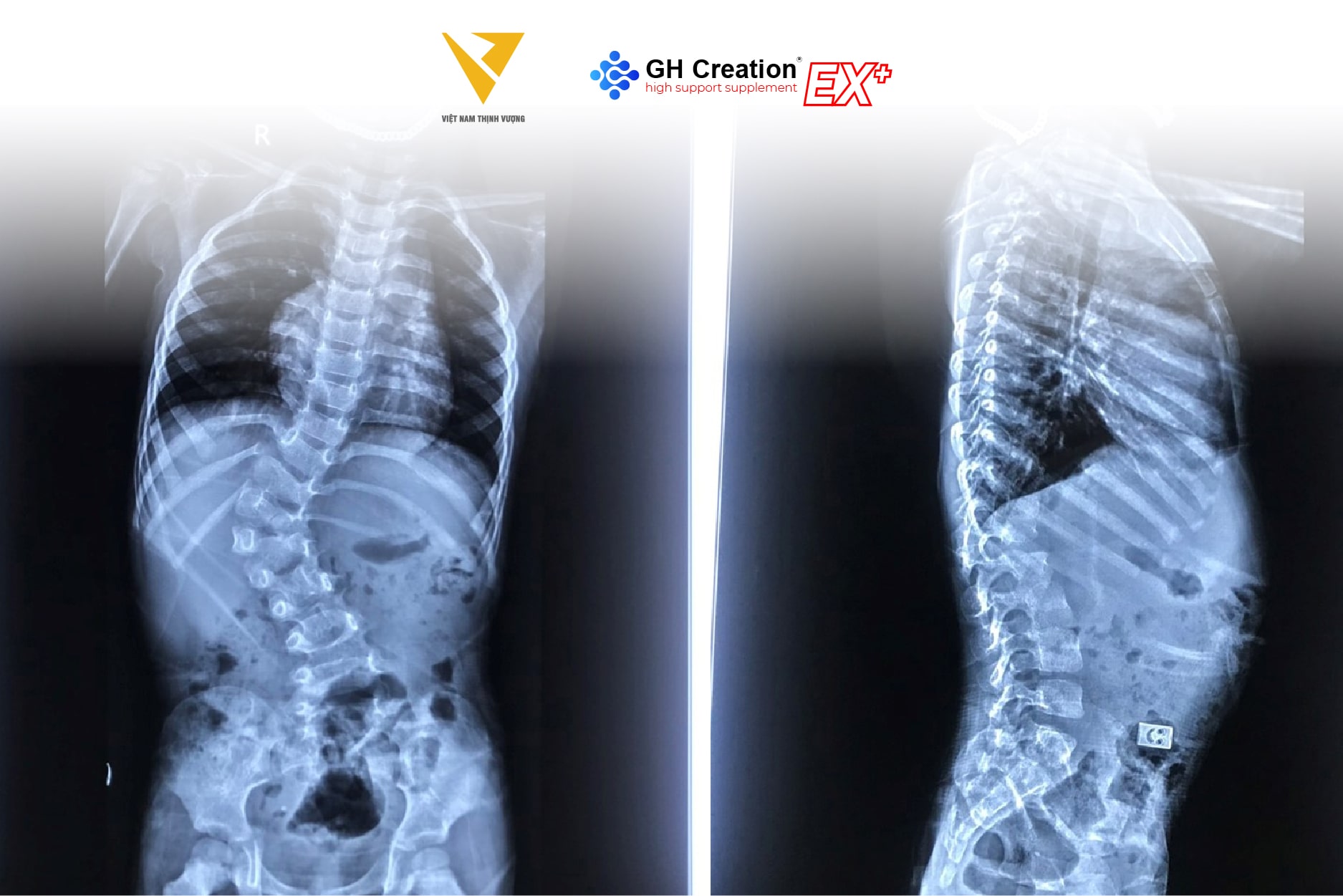 Cong vẹo cột sống ngực (Scoliosis)