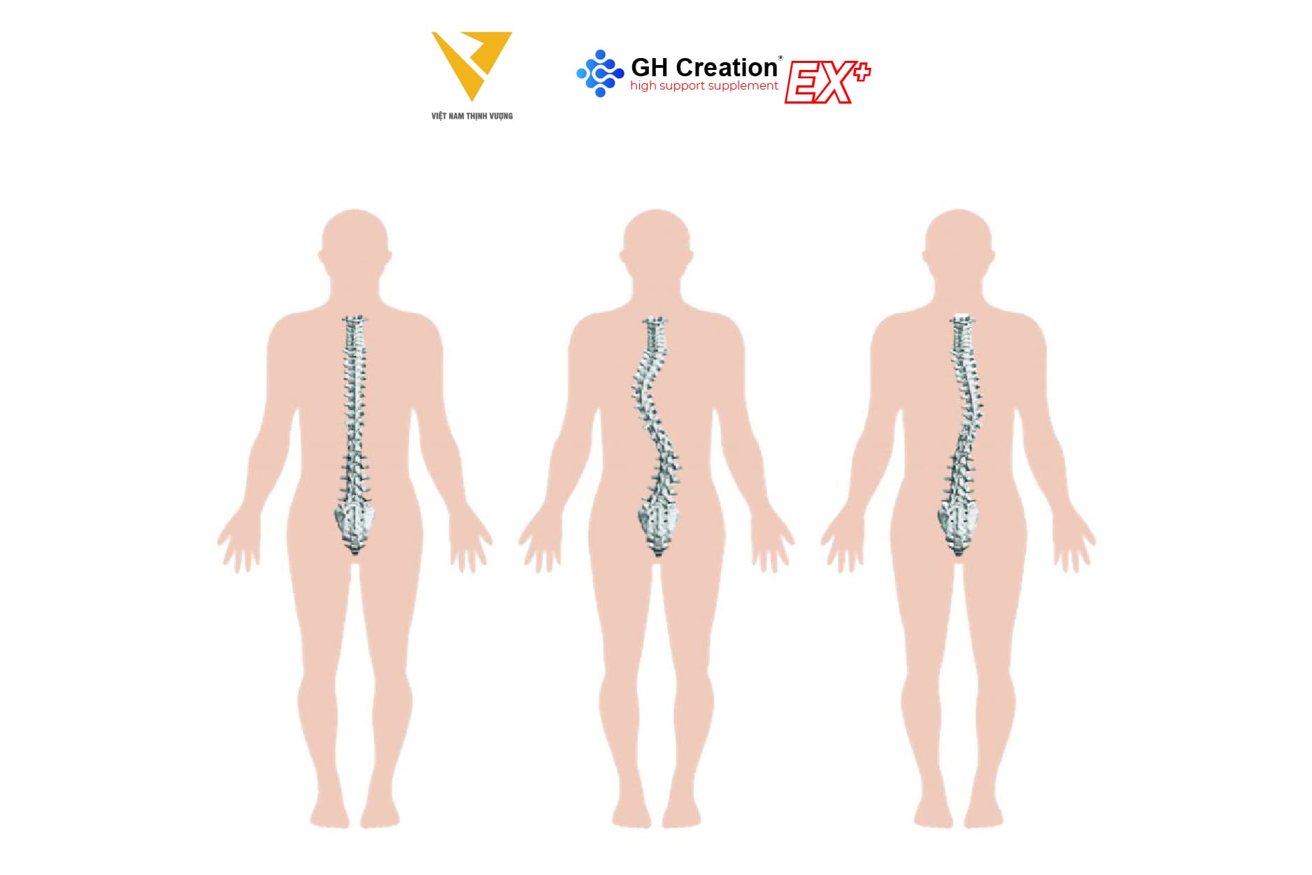 Cong vẹo cột sống thắt lưng (Lordosis)